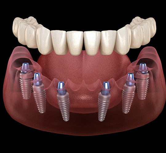 A digital image of 6 dental implants surgically placed into the jawbone while a custom denture is placed on top of the implants