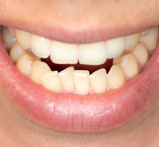 An up-close view of a person’s lower teeth that appear crowded