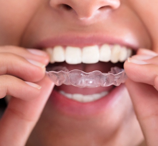 A woman inserting an Invisalign aligner