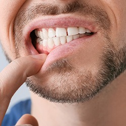 Man with facial hair pulling down lip to show inflamed gums
