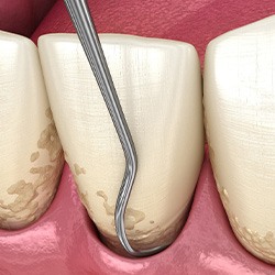 Illustration of teeth during scaling and root planing