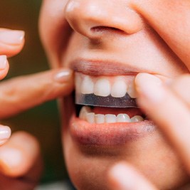 Closeup of patient putting on whitening strip