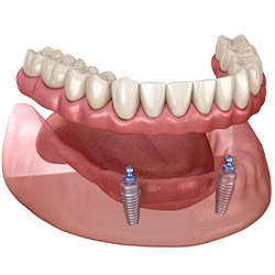 3D graphic of implant dentures 