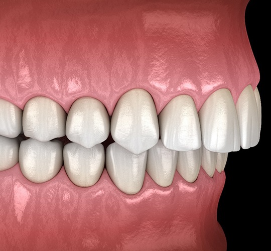 A digital image of an overbite with the upper teeth protruding out and over the bottom teeth