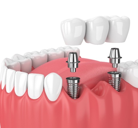 A digital image of an implant bridge  