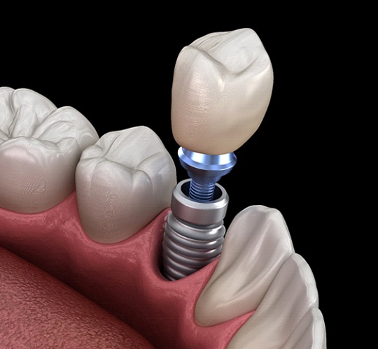 A single dental implant