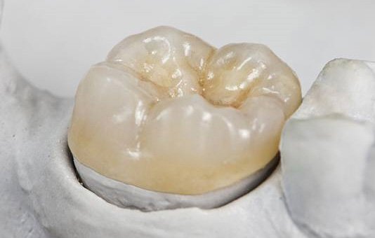 A single dental crown 