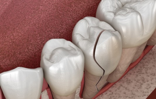 Cracked tooth needing a dental crown  