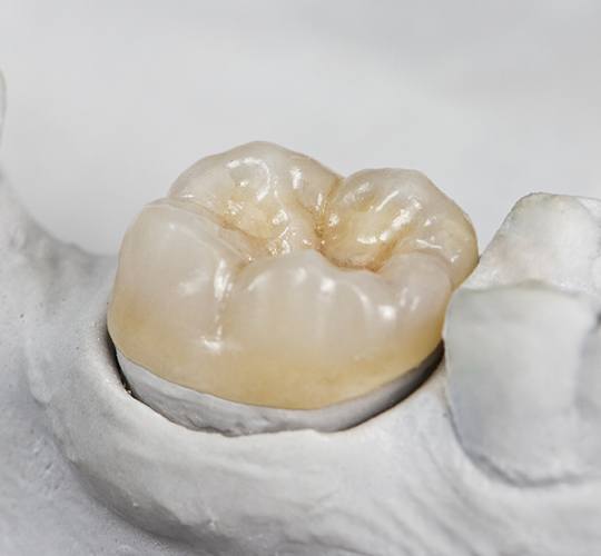 dental crown