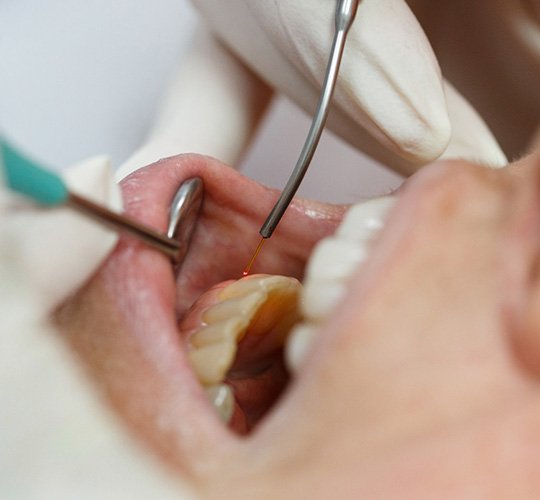 a soft tissue laser being used on a patient’s gums during a dental treatment