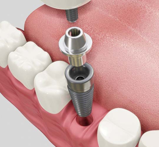 Diagram showing how dental implants in Westport work