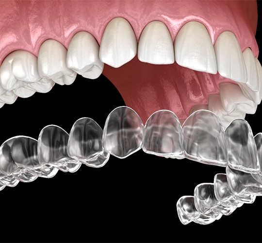 A diagram of an Invisalign aligner fitting over a top row of teeth