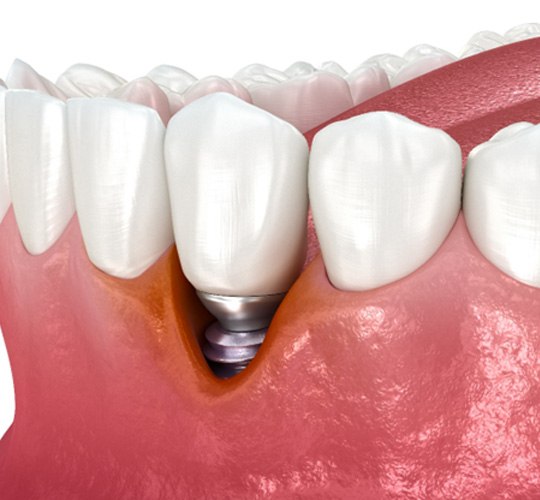 Failed dental implant in Westport 