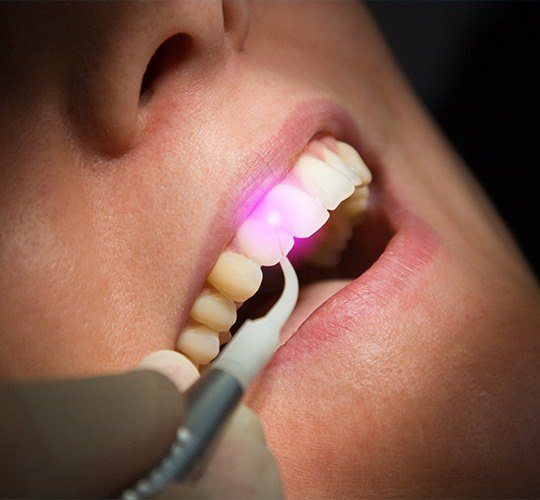 soft tissue laser on top of tooth