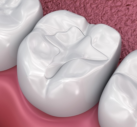 illustration of tooth colored fillings