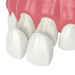 Veneers in Westport