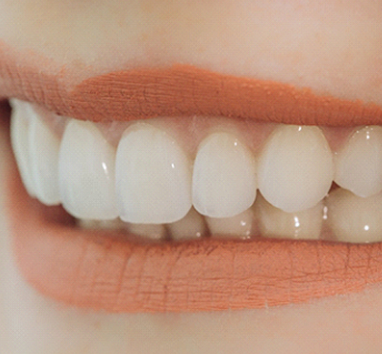 A person’s smile, complete with veneers placed along the top row of teeth