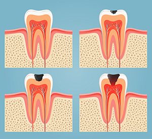  Stages of Tooth Decay