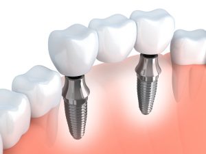 Dental implants of westport
