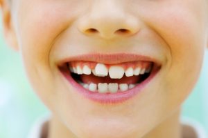 How crooked teeth can affect your child’s health with your dentist in Westport.