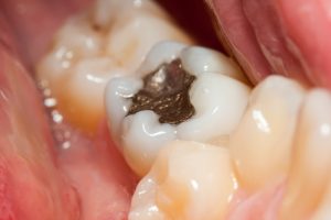 Why would my dentist in Westport want to remove my metal fillings?