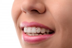 smile with Invisalign 