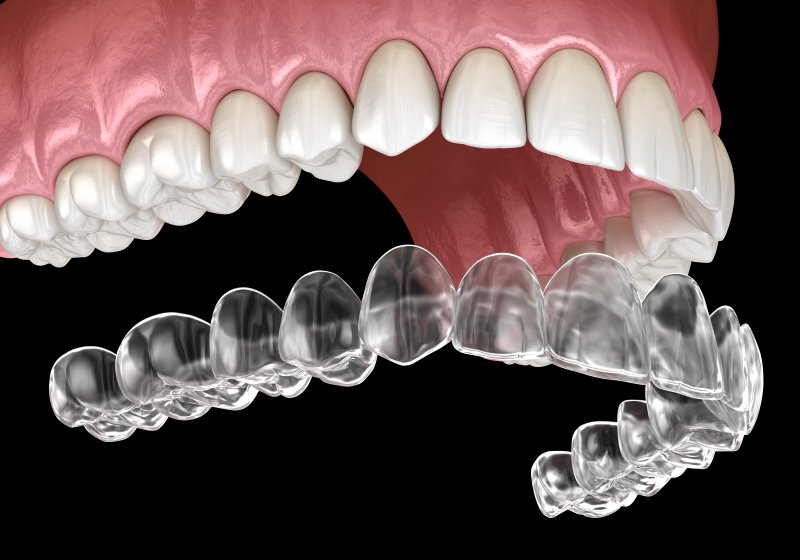 a digital image of an Invisalign clear aligner going on over a top row of teeth