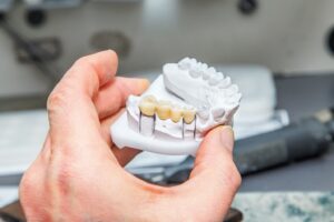 Hand holding teeth model with dental bridge on it.